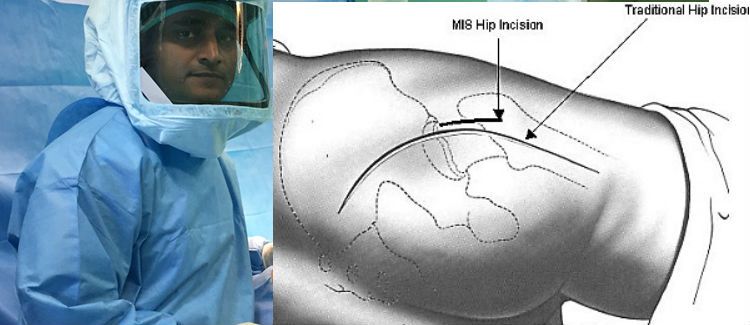 Minimally Invasive HIP Replacement