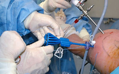 Shoulder Arthroscopy