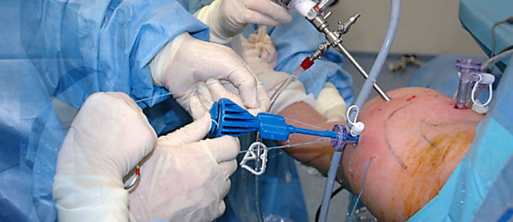 Shoulder Arthroscopy