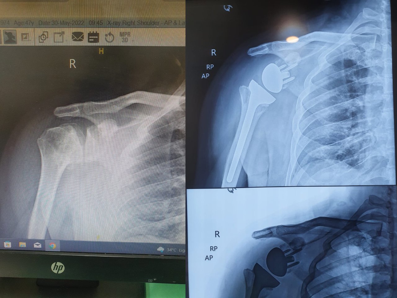 Six weeks after reverse shoulder arthroplasty