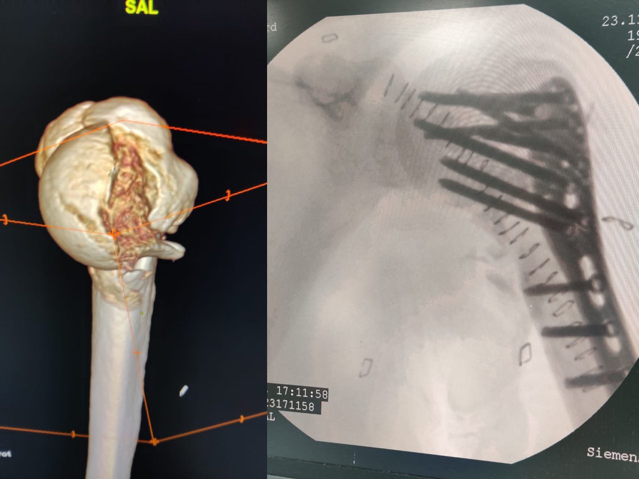 Complex shoulder injury reconstruction Part 1