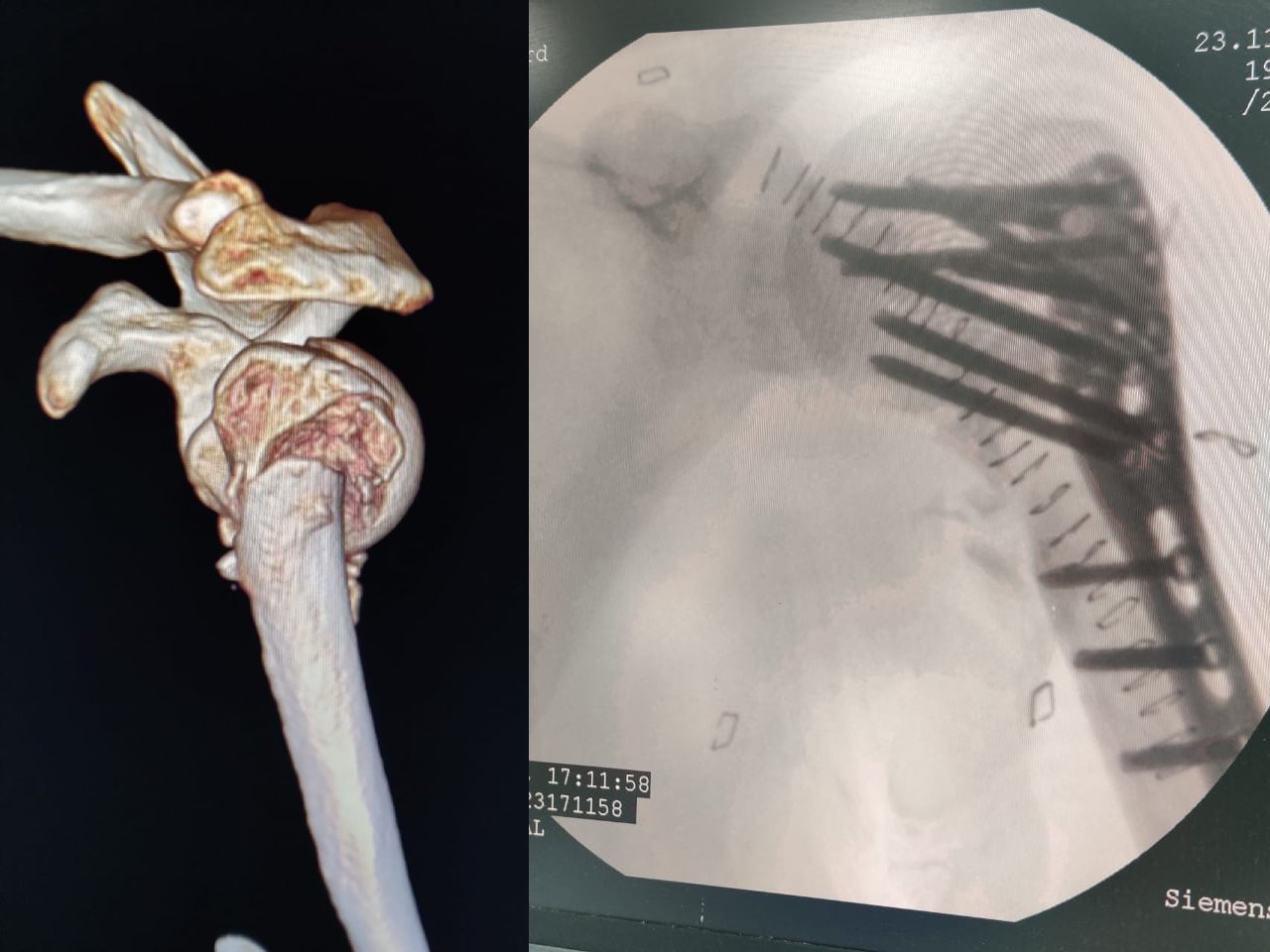 Complex shoulder injury reconstruction Part 3