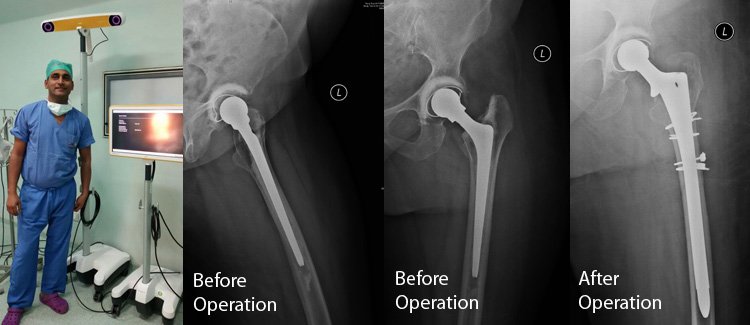 Revision Total Hip Replacement