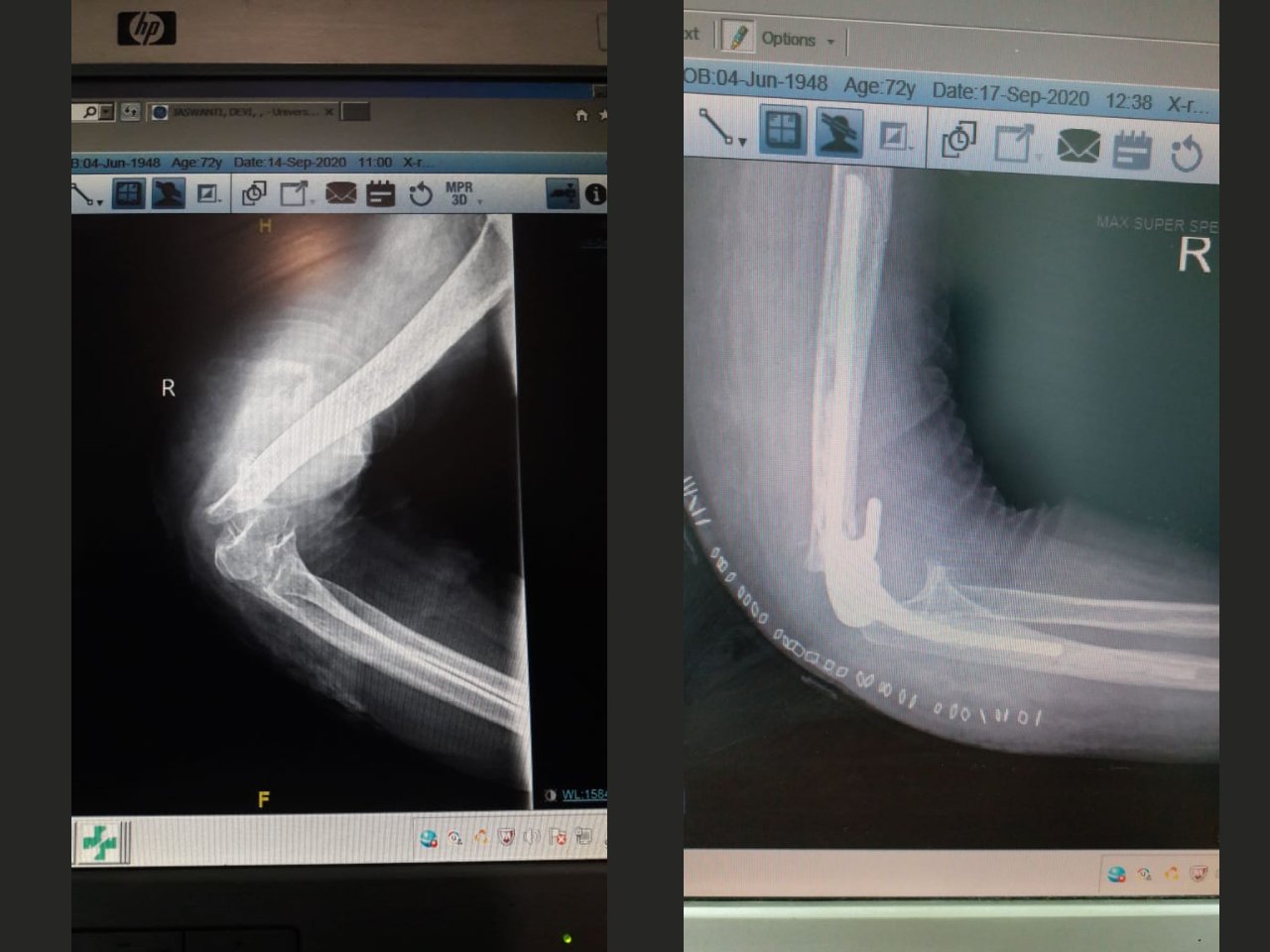 Total Elbow Replacement